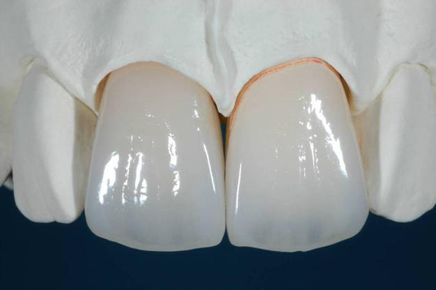 Răng toàn sứ Ceramill Zolid